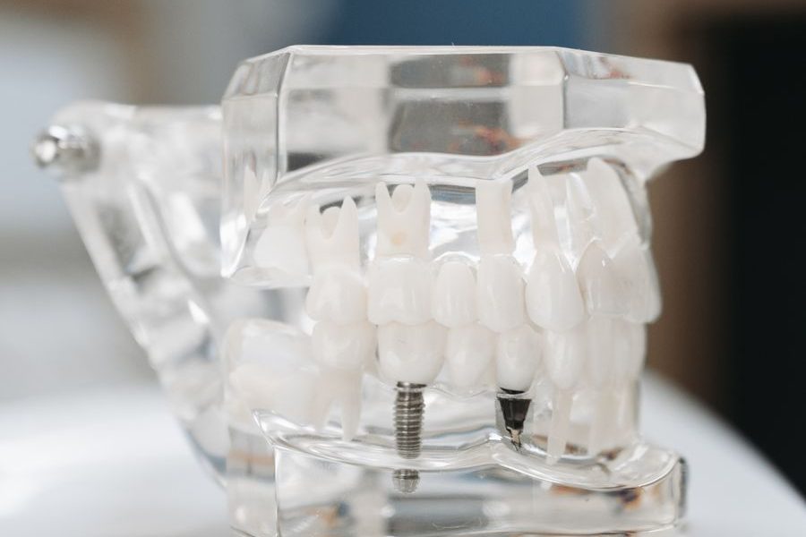 Restored smile with implants