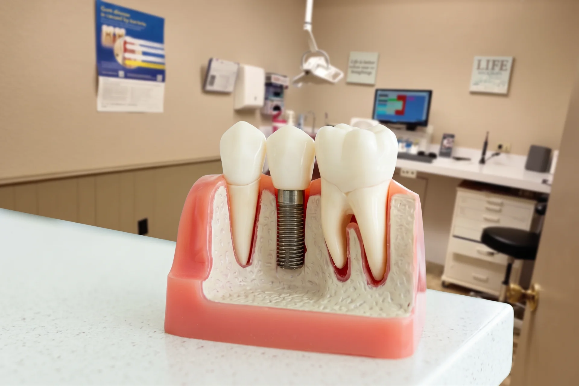 Dental implants at Watauga Family Dentistry